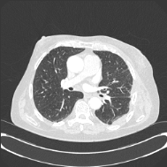 Axial CT preview for teaching case TS-s0223