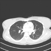 Axial CT preview for teaching case TS-s0310